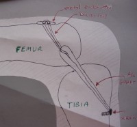 Diagram of how ACL graft is attached to tibia and femur